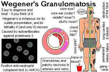 Cartoon Graphic by Ed Friedlander, M.D., Pathologist, Wegener's Granulomatosis